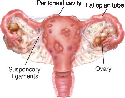 อาการ Endometriosis