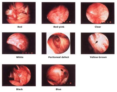 อาการ Endometriosis